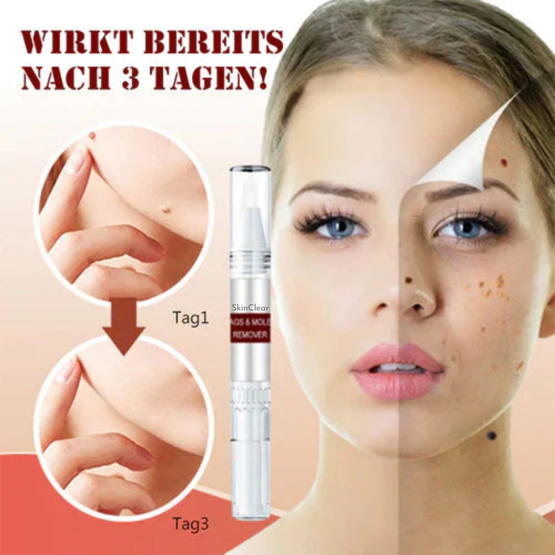 1+1 Gratis! - SkinClear™ Tags & Maulwurfsentferner