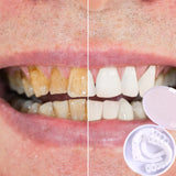 SmileSnap™ - Immer das perfekte Lächeln mit diesen Veneers